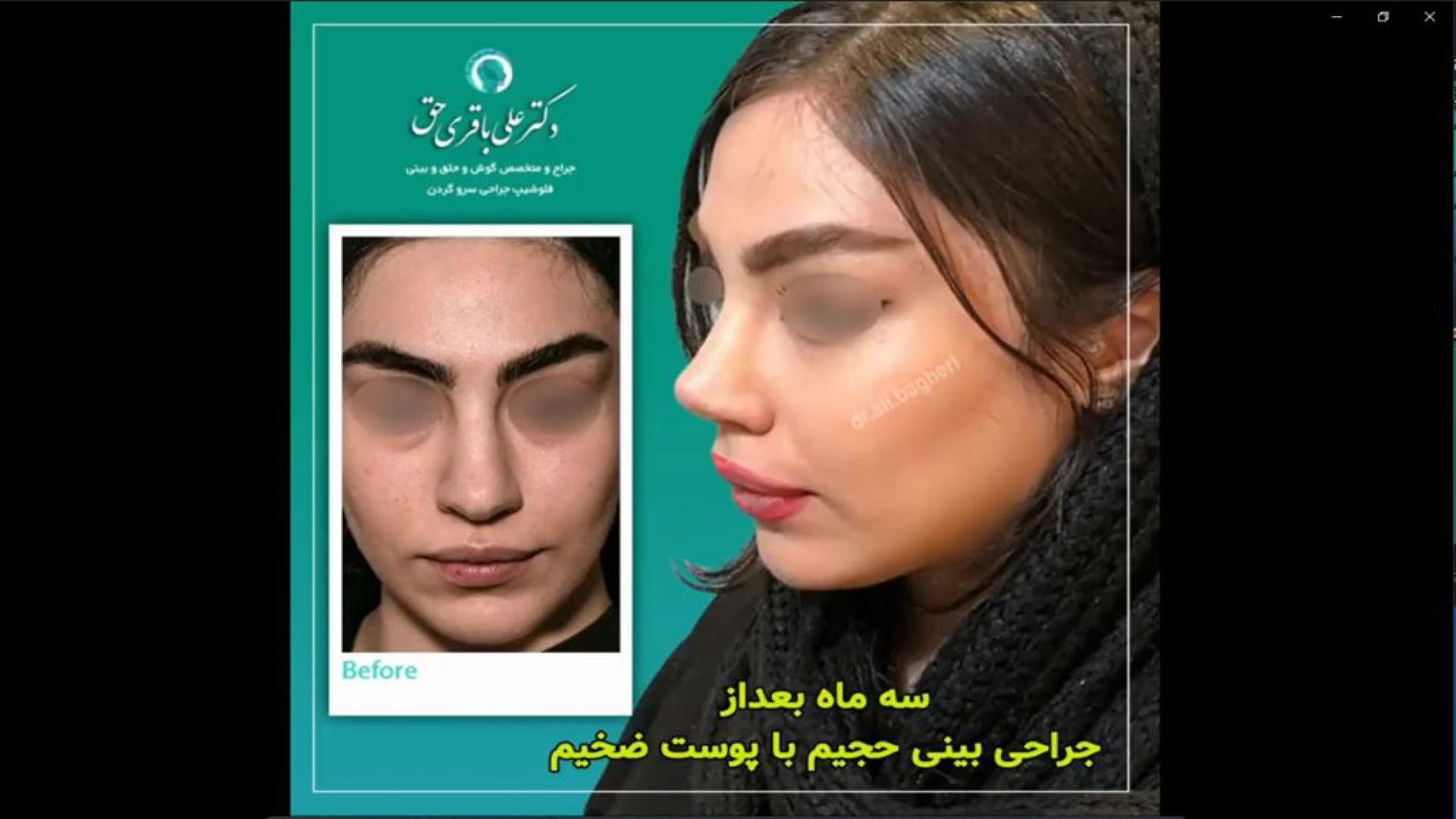 سه ماه بعد از جراحی بینی حجیم با پوست ضخیم | دکتر باقری حق دکتر علی باقری حق