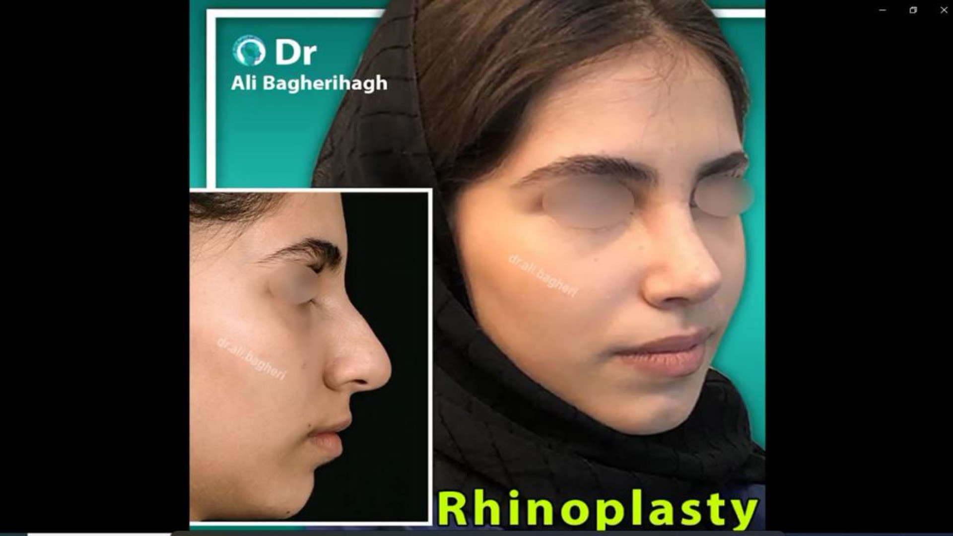 جراحی زیبایی بینی | دکتر باقری حق دکتر علی باقری حق
