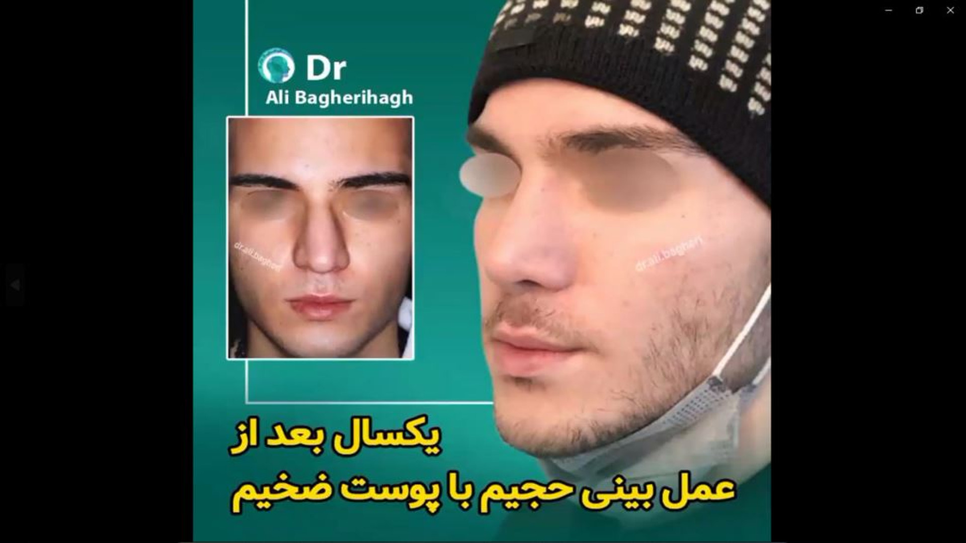 یک سال بعد از جراحی بینی حجیم با پوست ضخیم دکتر علی باقری حق