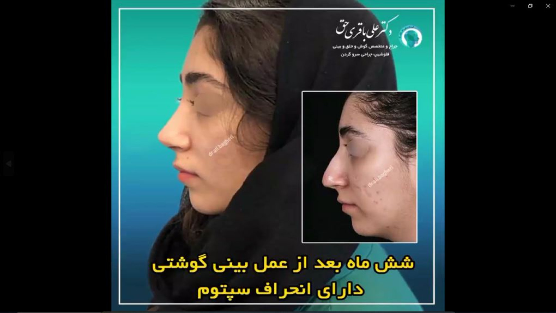 شش ماه بعد از عمل بینی گوشتی دارای انحراف سپتوم دکتر علی باقری حق