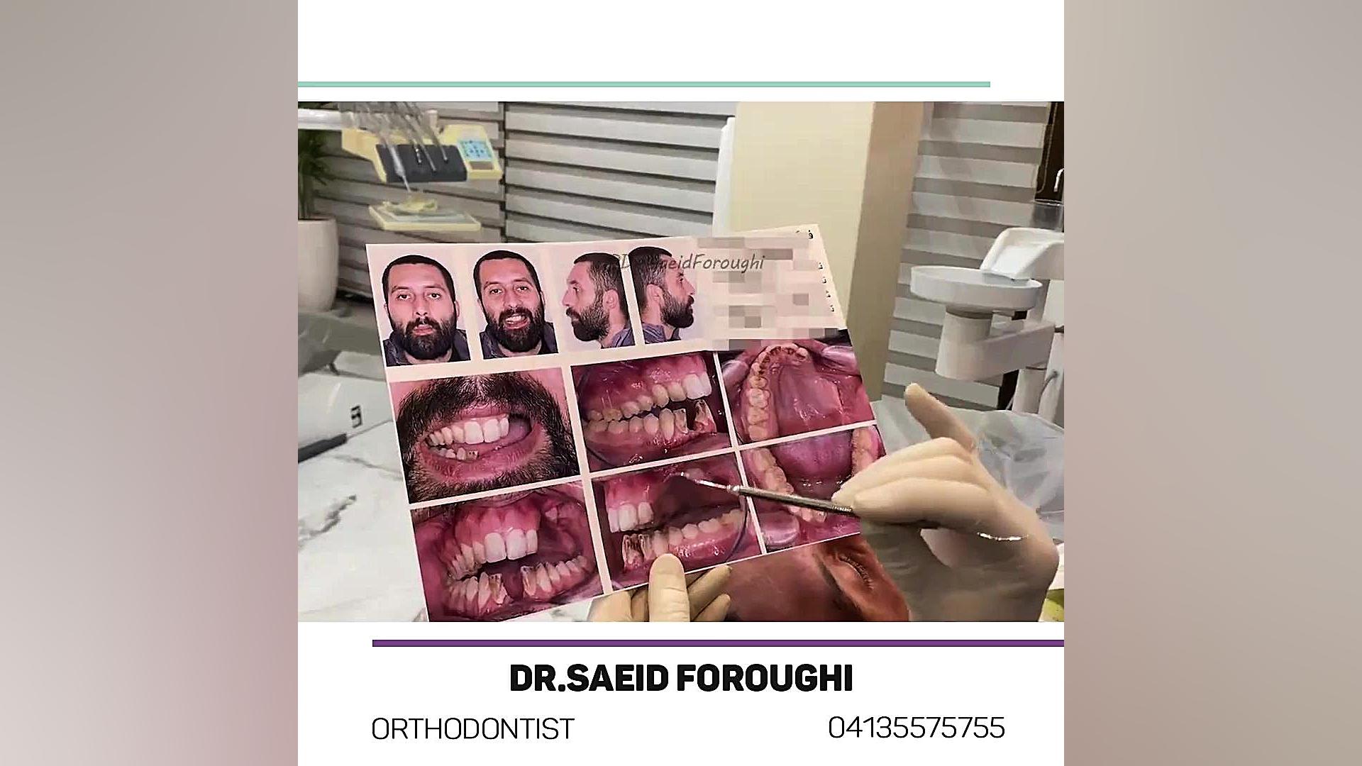 تصحیح اپن بایت قدامی با اینتروژن دندانهای خلفی دکتر سعید فروغی متخصص ارتودنسی