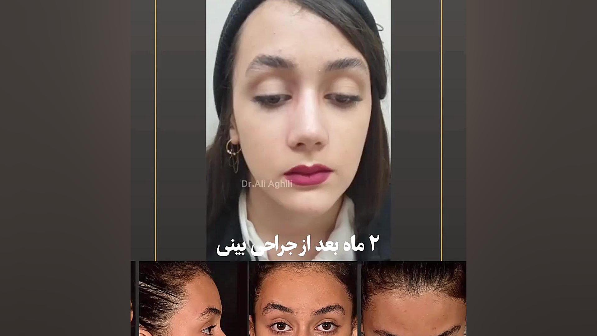 دو ماه بعد از عمل بینی نسبتا گوشتی و رضایت زیباجو دکتر علی عقیلی - جراح بینی در تهران