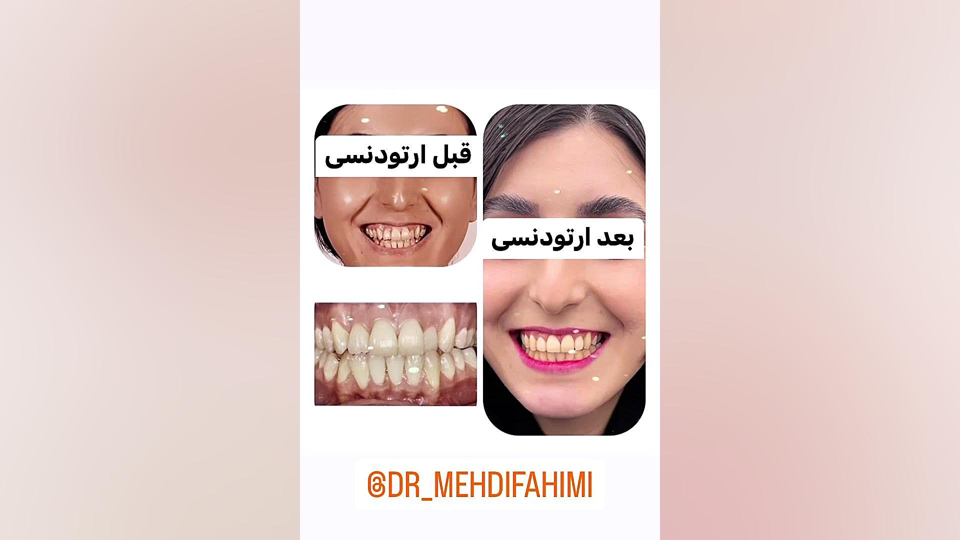ارتودنسی قبل و بعد دكتر مهدي فهيمي هنزائي