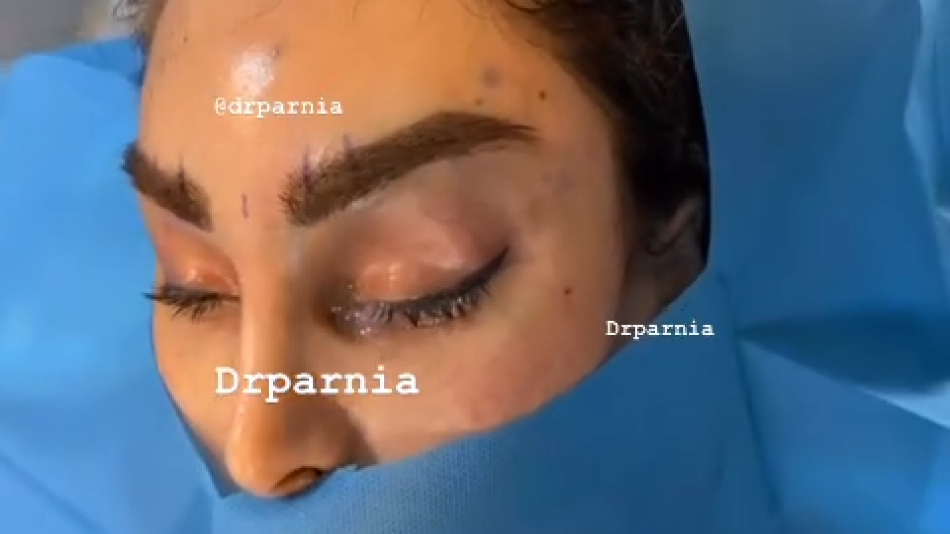 لیفت آندوسکوپیک پیشانی و ابرو دکتر رفیع پرنیا فوق تخصص پلاستیک