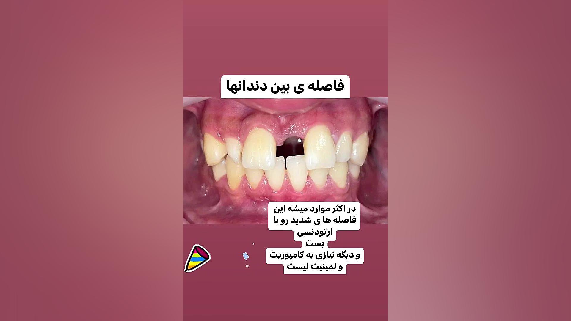 فاصله بین دندانی دكتر مهدي فهيمي هنزائي