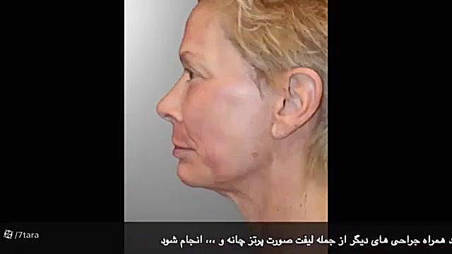 توضیحات کامل لیفت گردن تست لوسمی باقی‌مانده