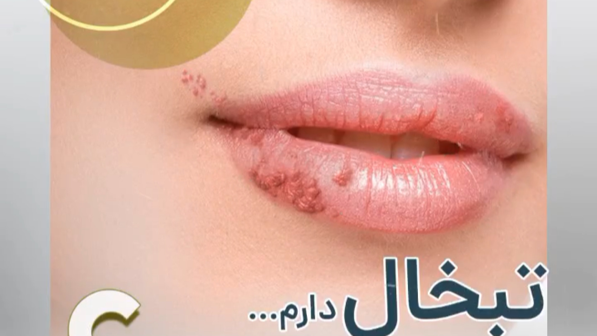 لیزر کردن محل تبخال دکتر ایمان روغنی جراح و متخصص پوست و مو