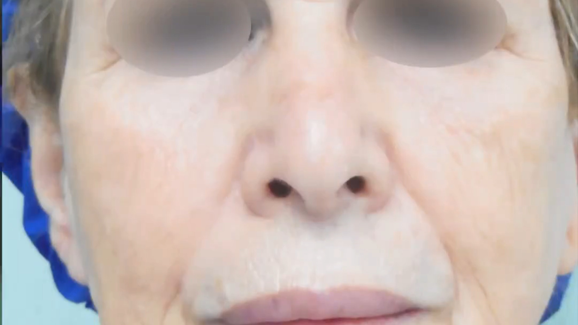 نتیجه جراحی لیفت صورت و گردن دکتر محمدرضا آخوندی نسب-فوق تخصص جراحی پلاستیک