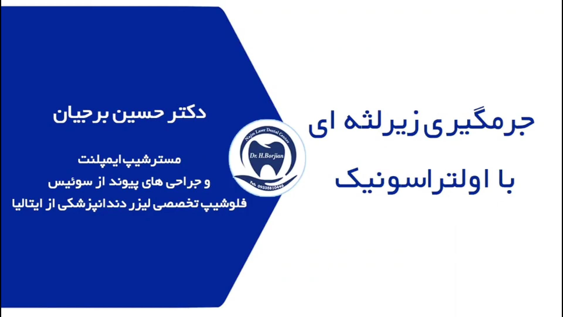 نمونه جرمگیری زیرلثه ای با اولتراسونیک | بهترین دندانپزشک زیبایی اصفهان تزریق چربی