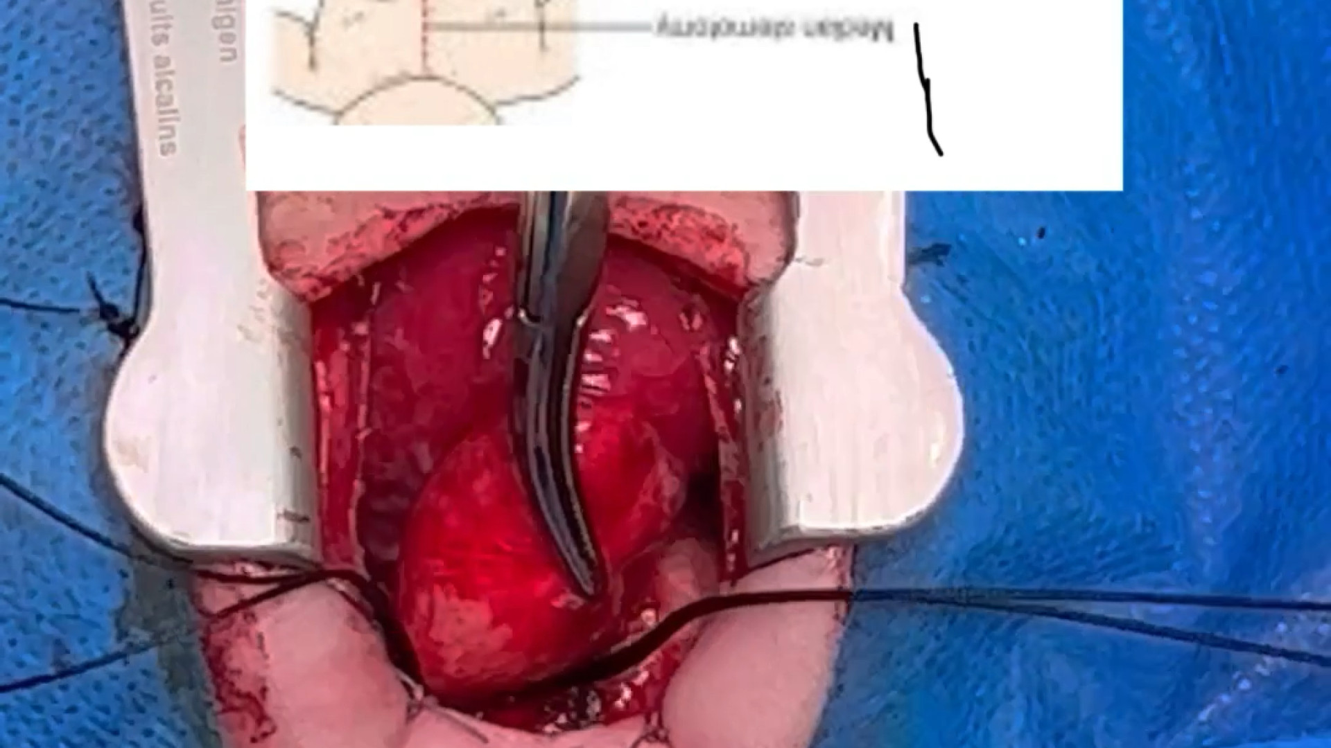 بيماري مادرزادي قلب_پي دي ا-دكترحدادزاده کله عنکبوت