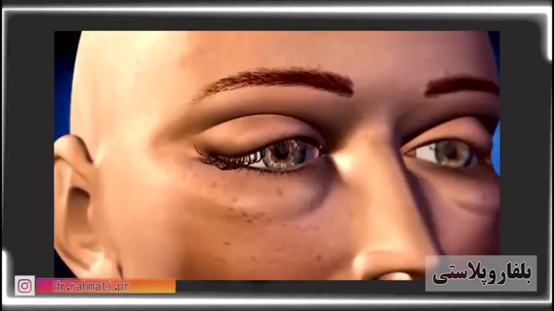 انیمیشن جراحی بلفاروپلاستی دکتر جواد رحمتی