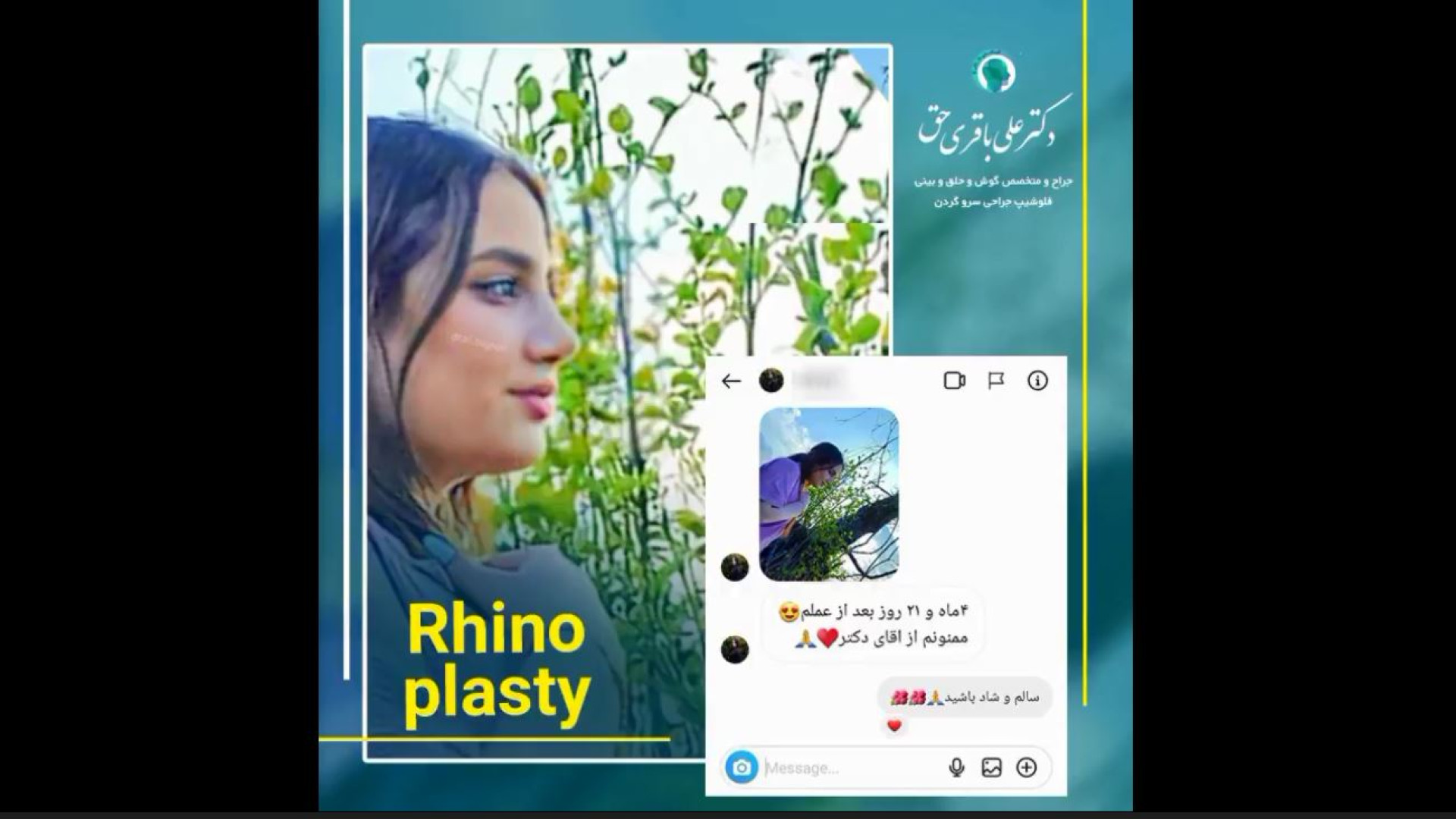 رضایت زیباجو عزیز | 4 ماه بعد از جراحی بینی دکتر علی باقری حق