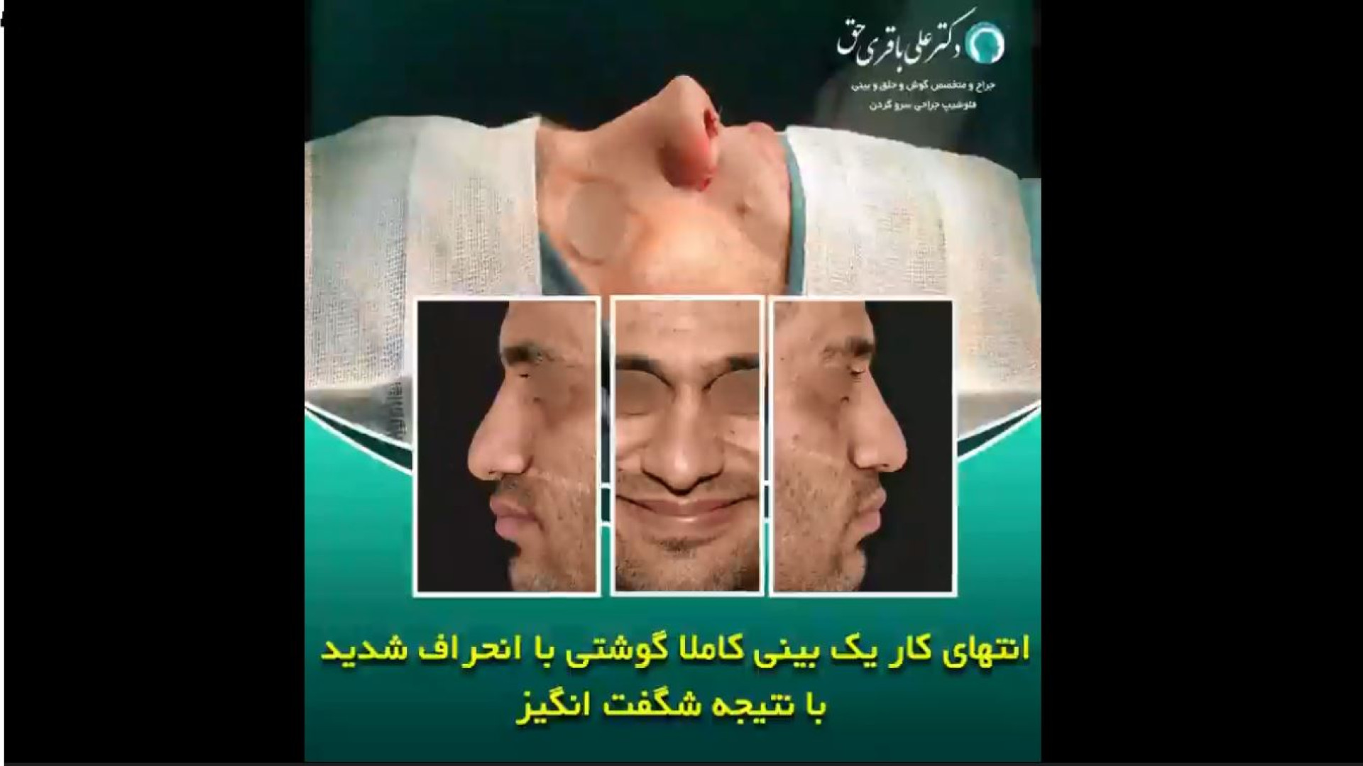جراحی بینی کاملا گوشتی با انحراف شدید با نتیجه شگفت انگیز دکتر علی باقری حق