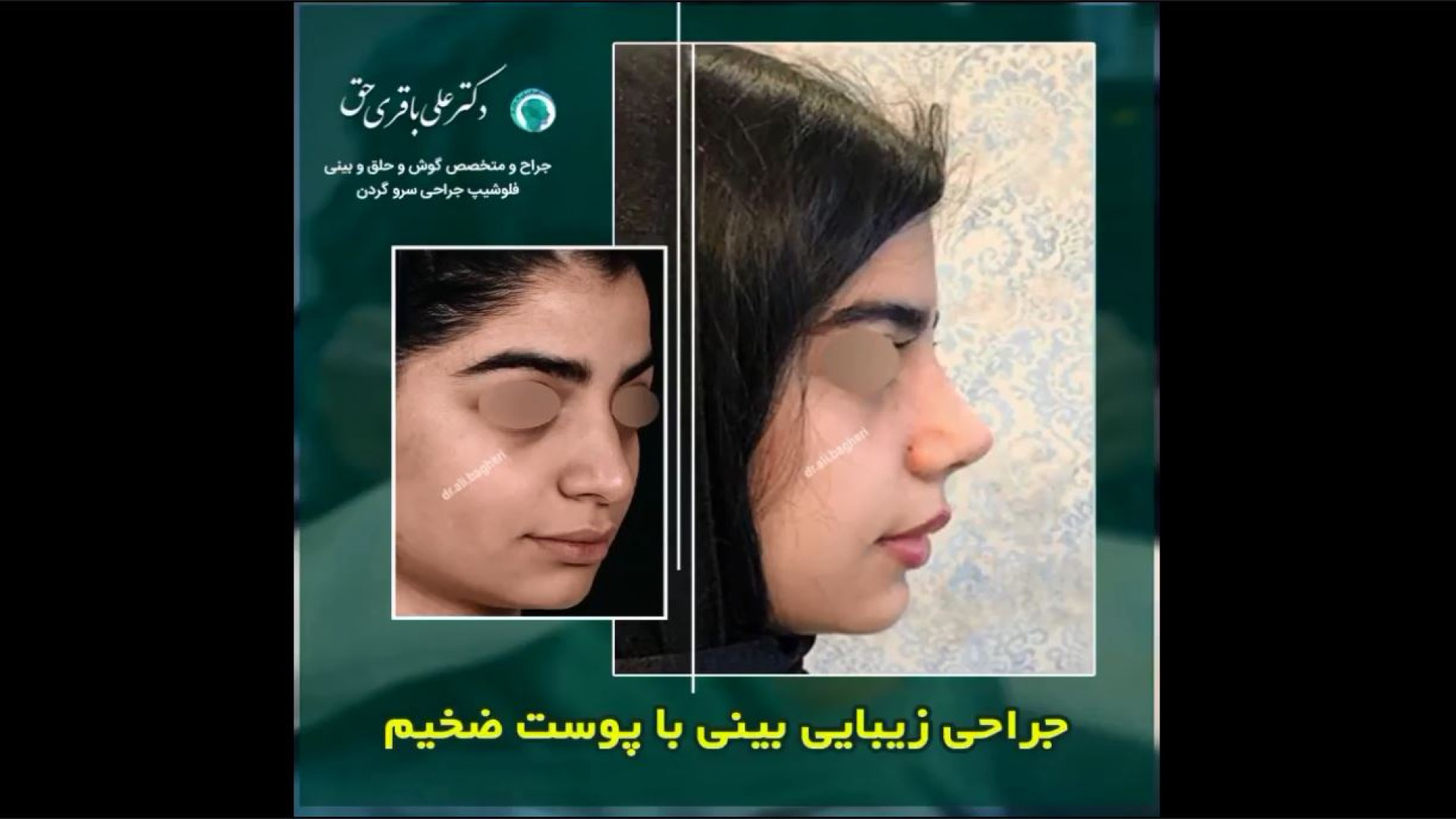 جراحی زیبایی بینی با پوست ضخیم دکتر علی باقری حق