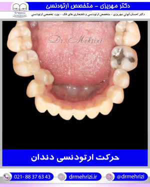 حرکت ارتودنسی دندان