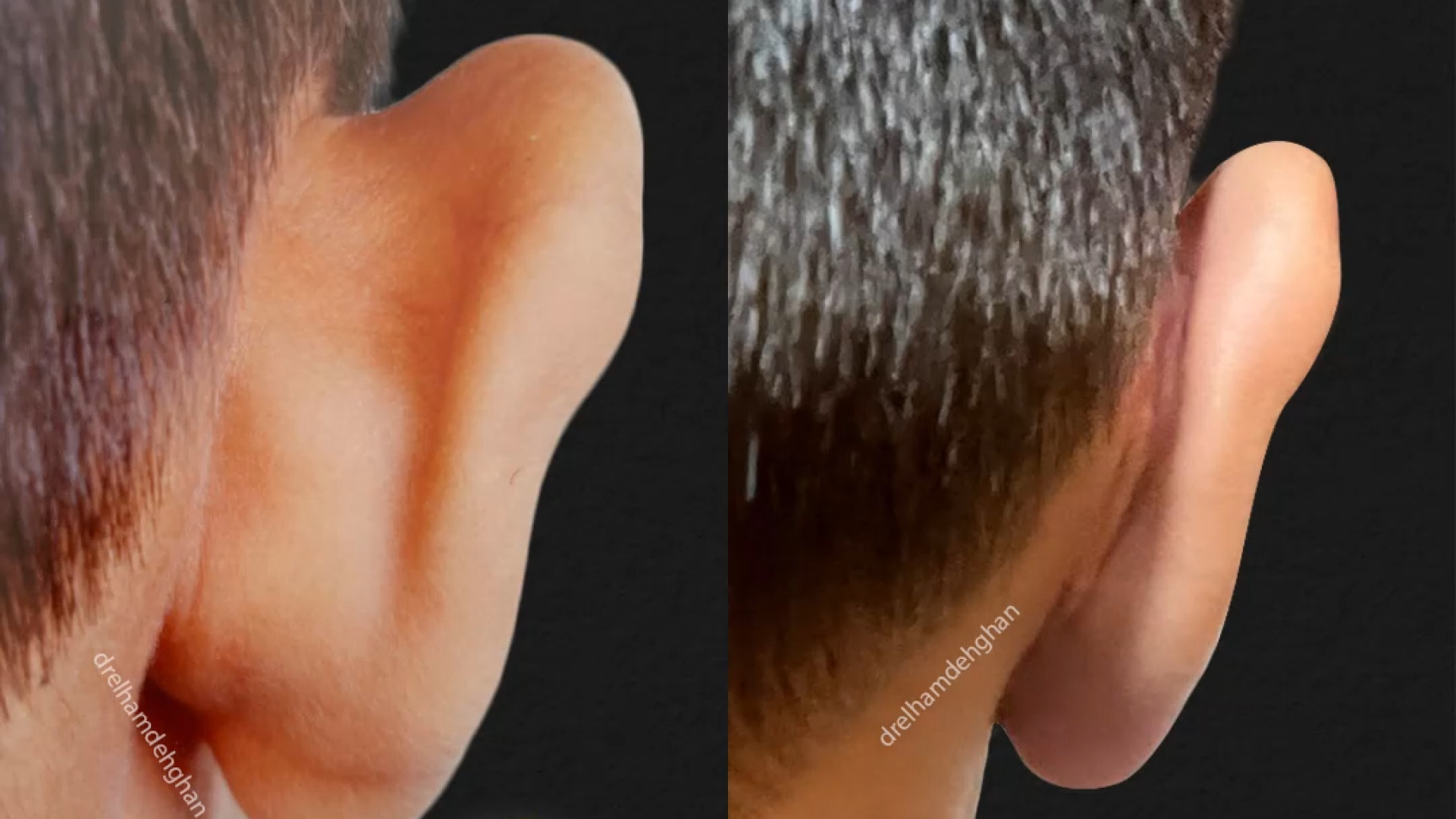 جراحی گوش (اتوپلاستی) لیزر مو