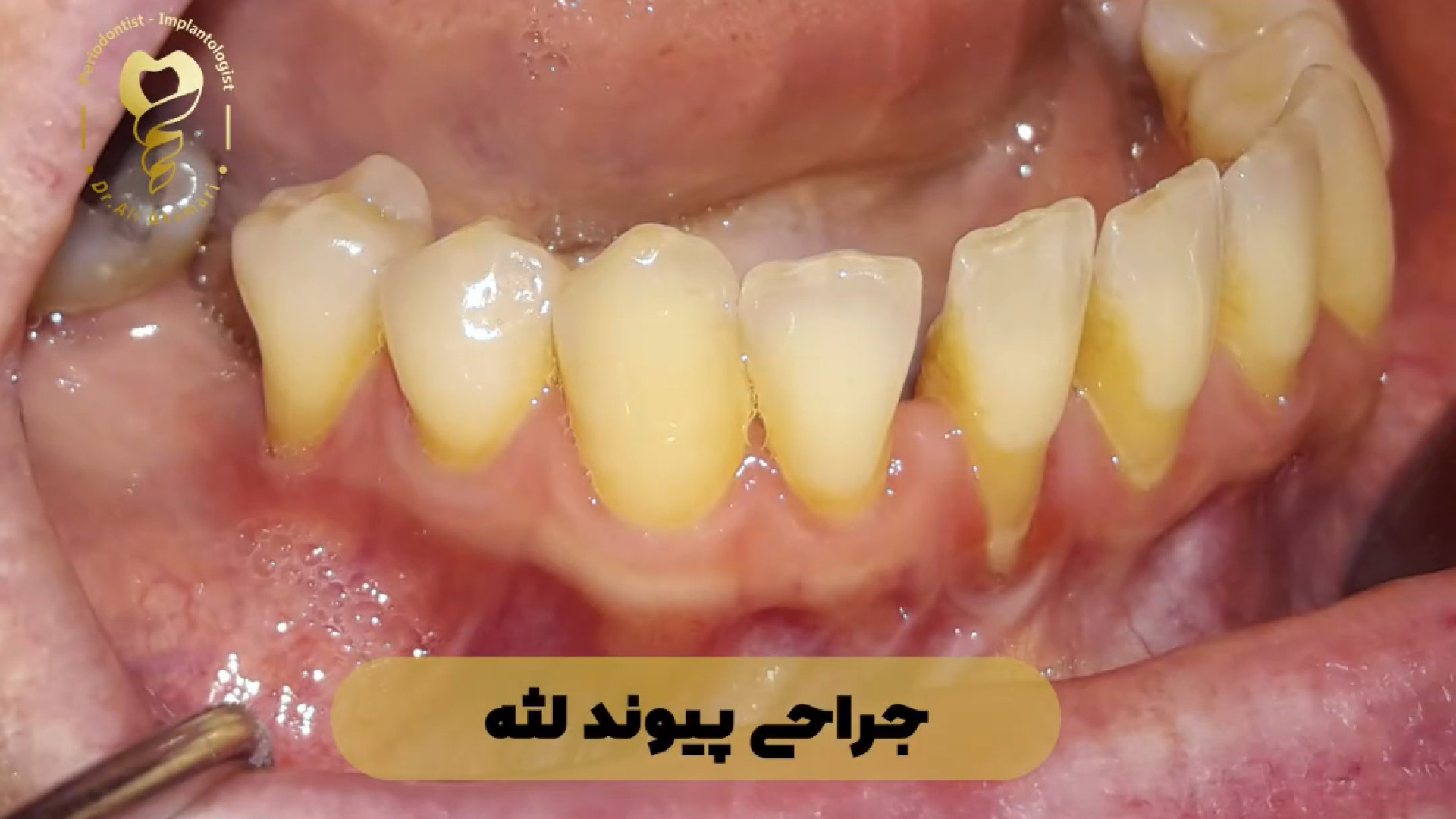 فیلم جراحی پیوند لثه دکتر علی قمری - متخصص جراحی لثه و ایمپلنت
