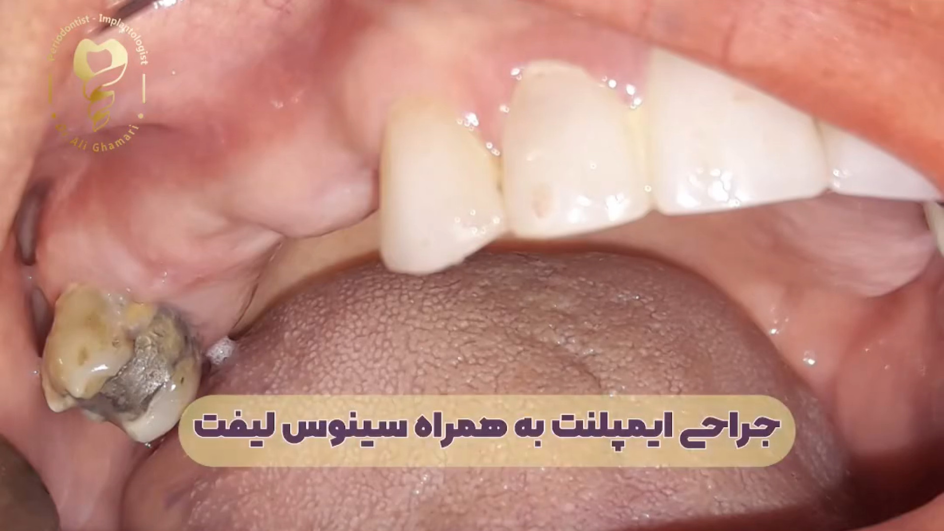 جراحی ایمپلنت به همراه سینوس لیفت دکتر علی قمری - متخصص جراحی لثه و ایمپلنت