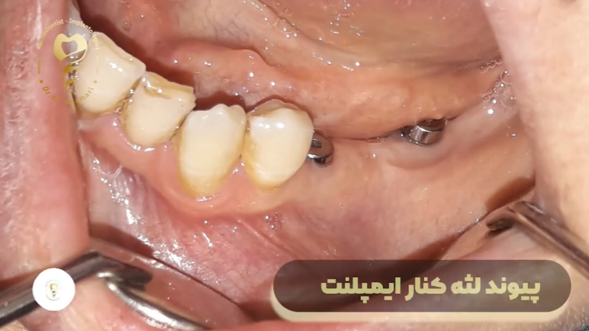 فیلم جراحی دو واحد ایمپلنت دندان همزمان جراحی پیوند لثه scATAC-Seq