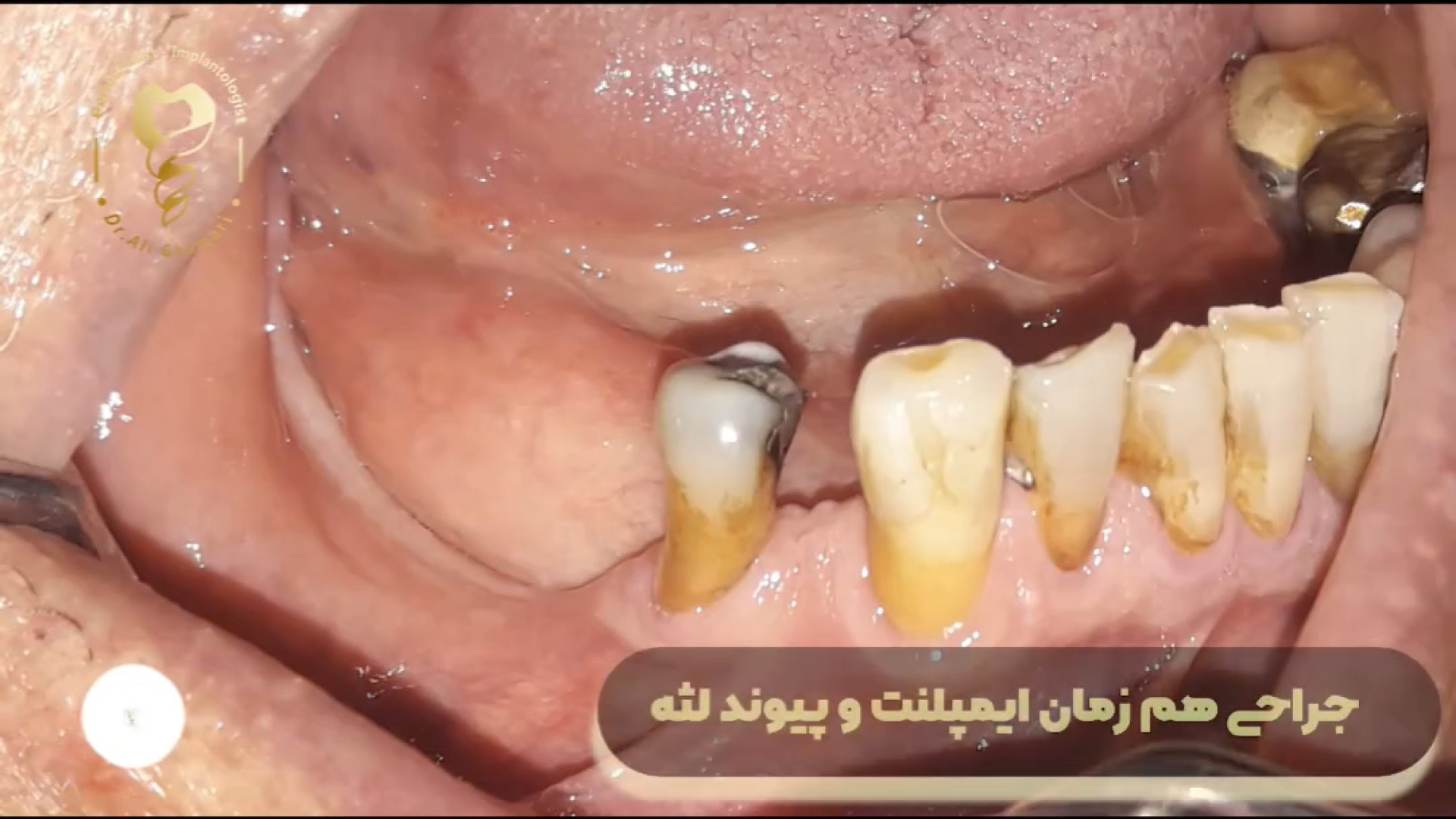 ایمپلنت همراه پیوند لثه فک پایین ابمابوسیکلیب
