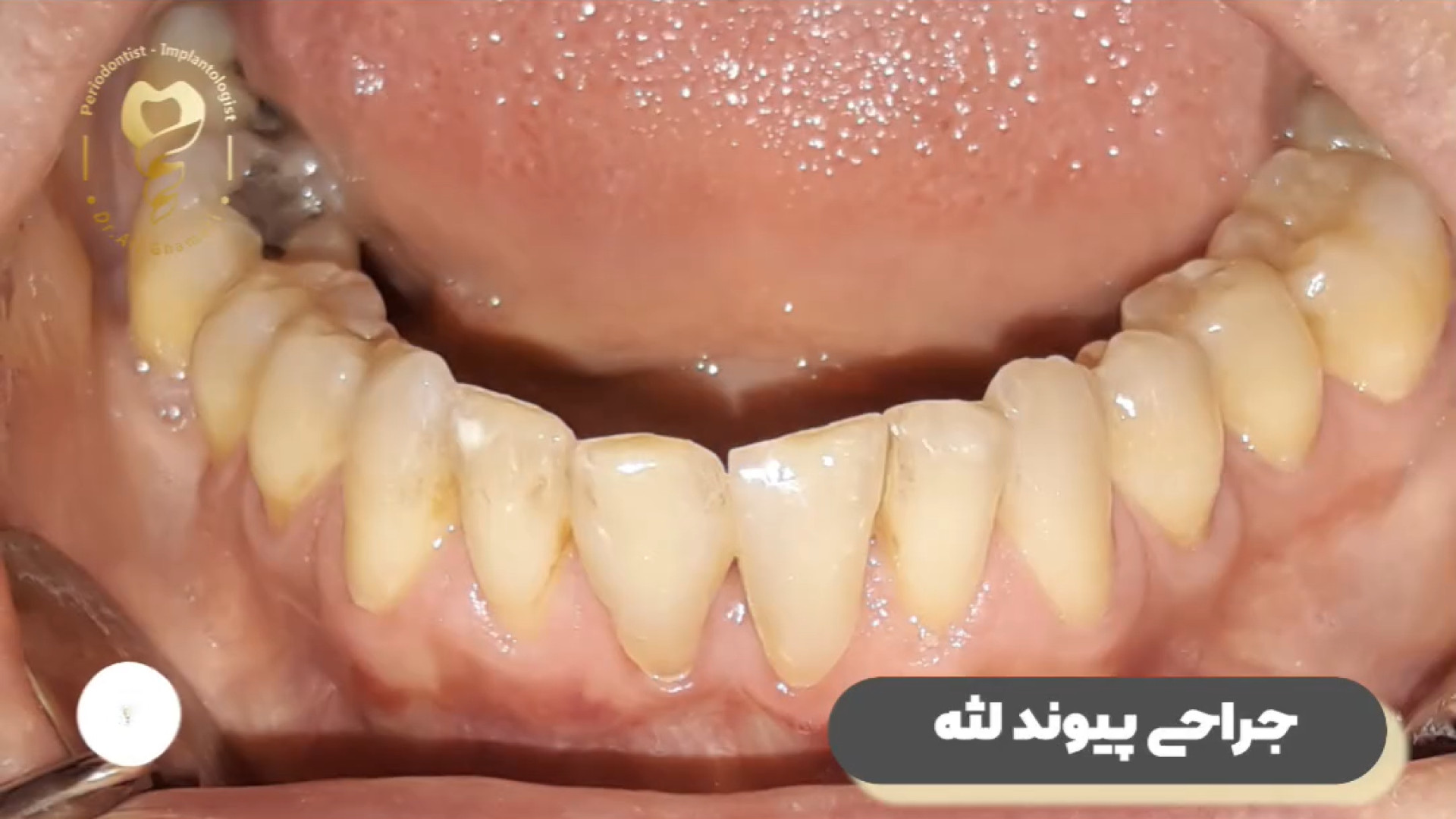 فیلم جراحی پیوند لثه فک پایین بیماری ترومبوسایتوز اسنشیال