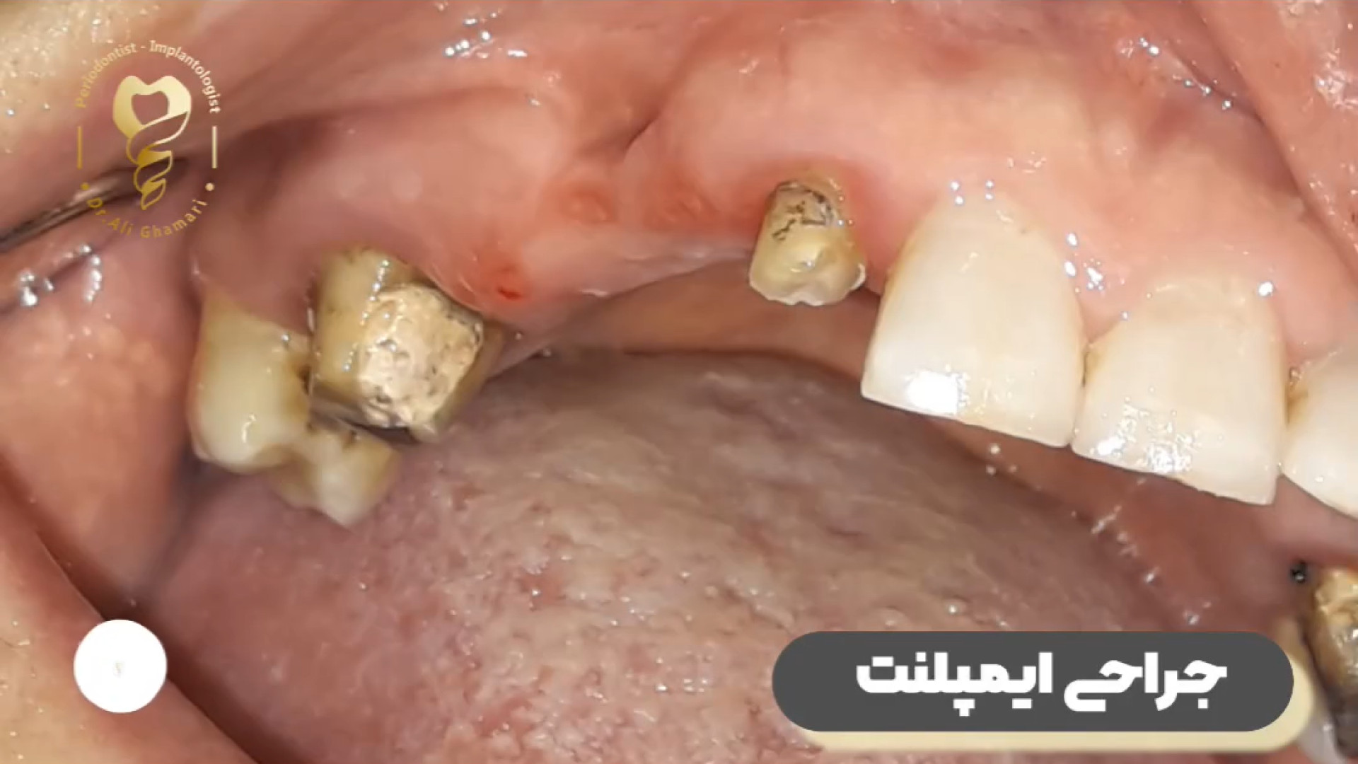 جراحی ایمپلنت دندان دکتر علی قمری - متخصص جراحی لثه و ایمپلنت