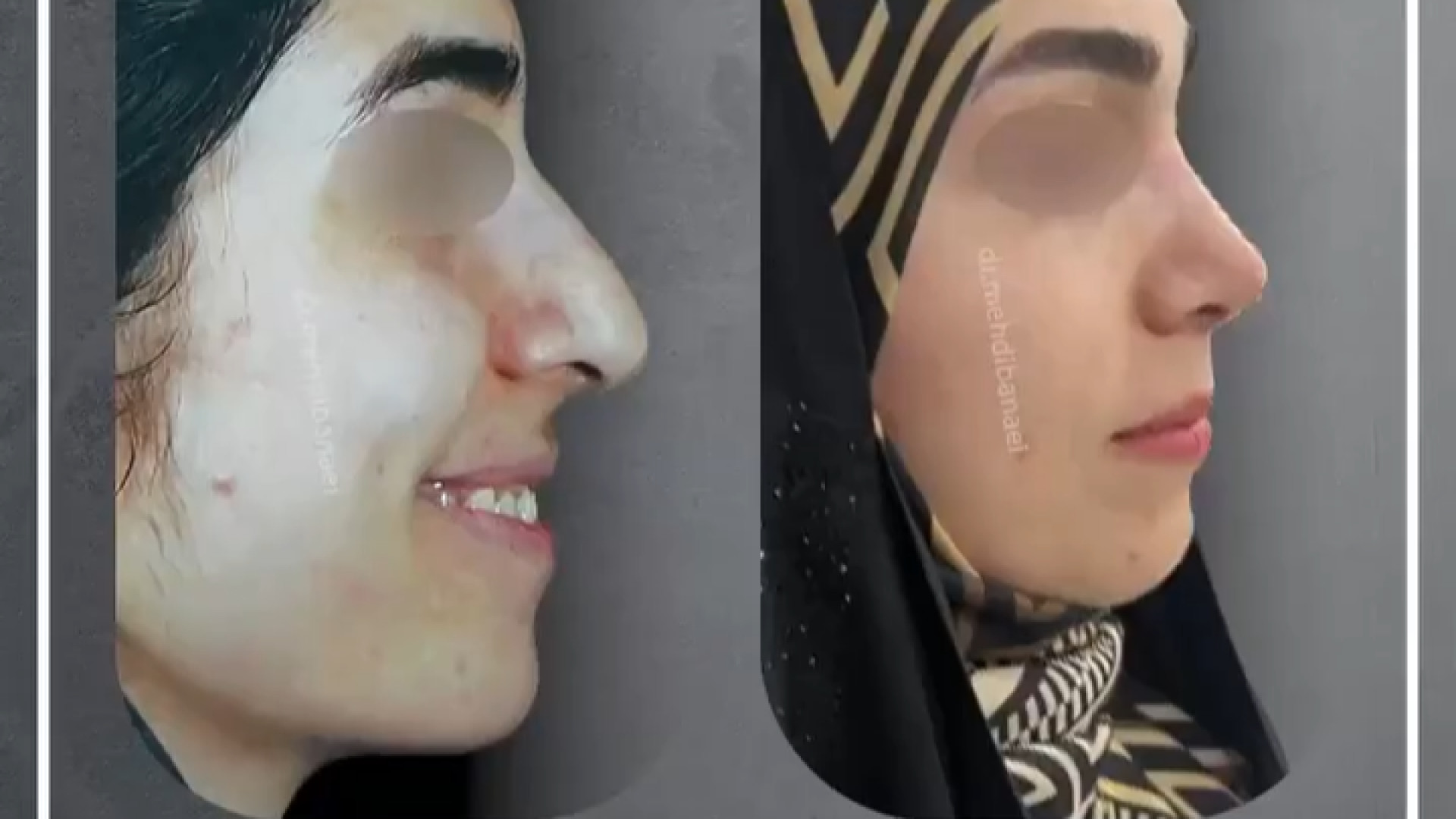 جراحی انحراف بینی