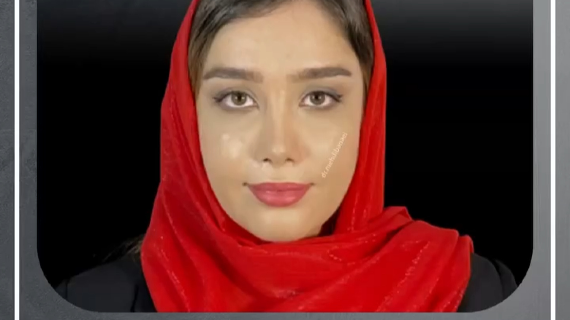 عمل زیبایی بینی توسط دکتر بنایی در ارومیه