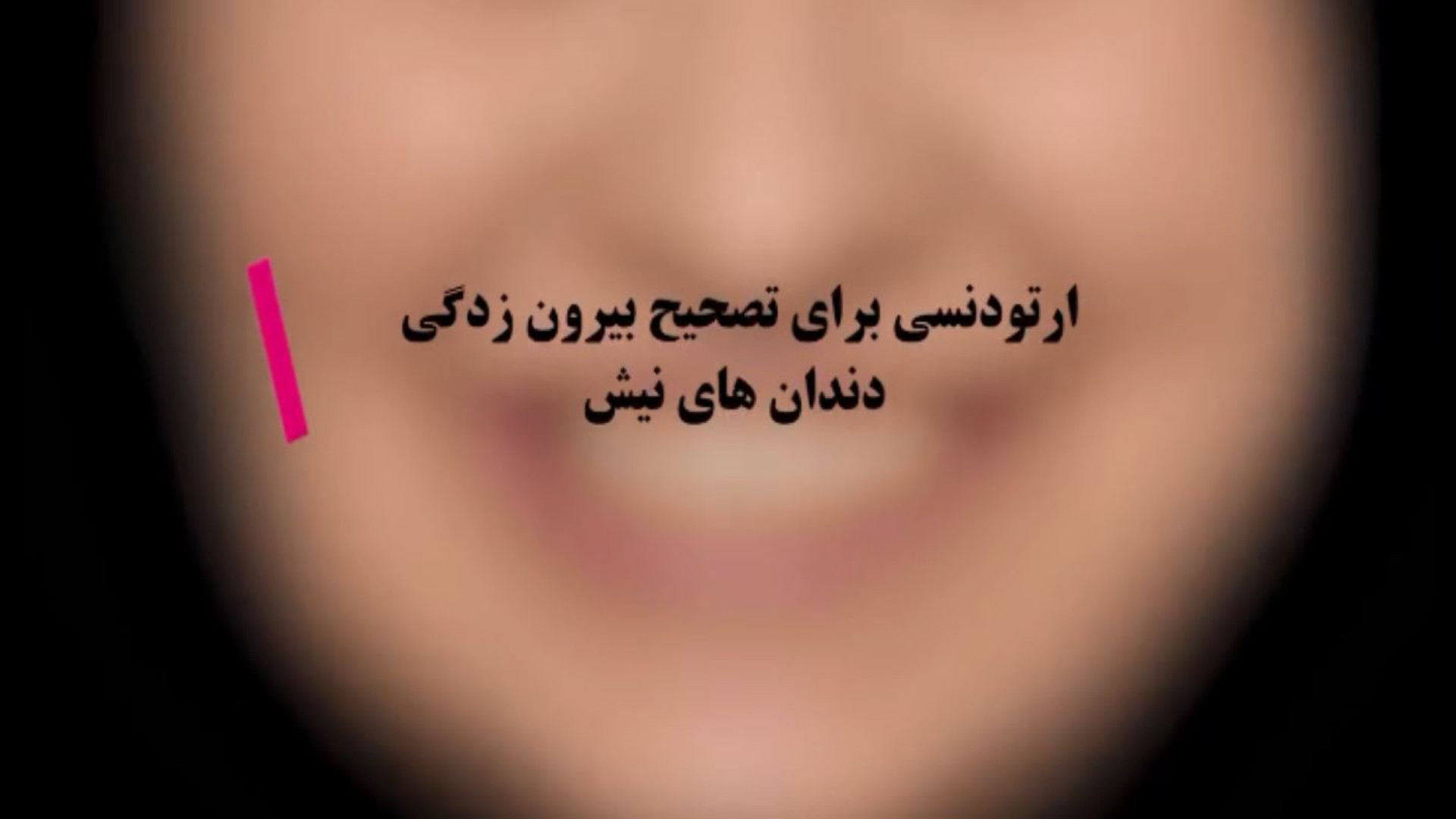ارتودنسی برای تصحیح بیرون زدگی دندان های نیش | دکتر اصلانی پزشکی میکروRNA