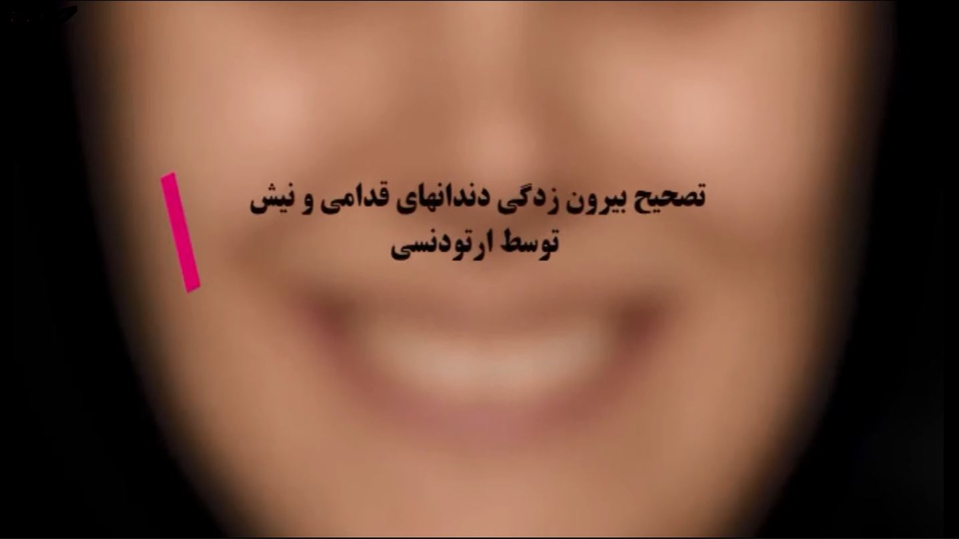 تصحیح بیرون زدگی دندان های قدامی و نیش با ارتودنسی | دکتر اصلانی دستگاه آنالیز ایمیجینگ سلول زنده