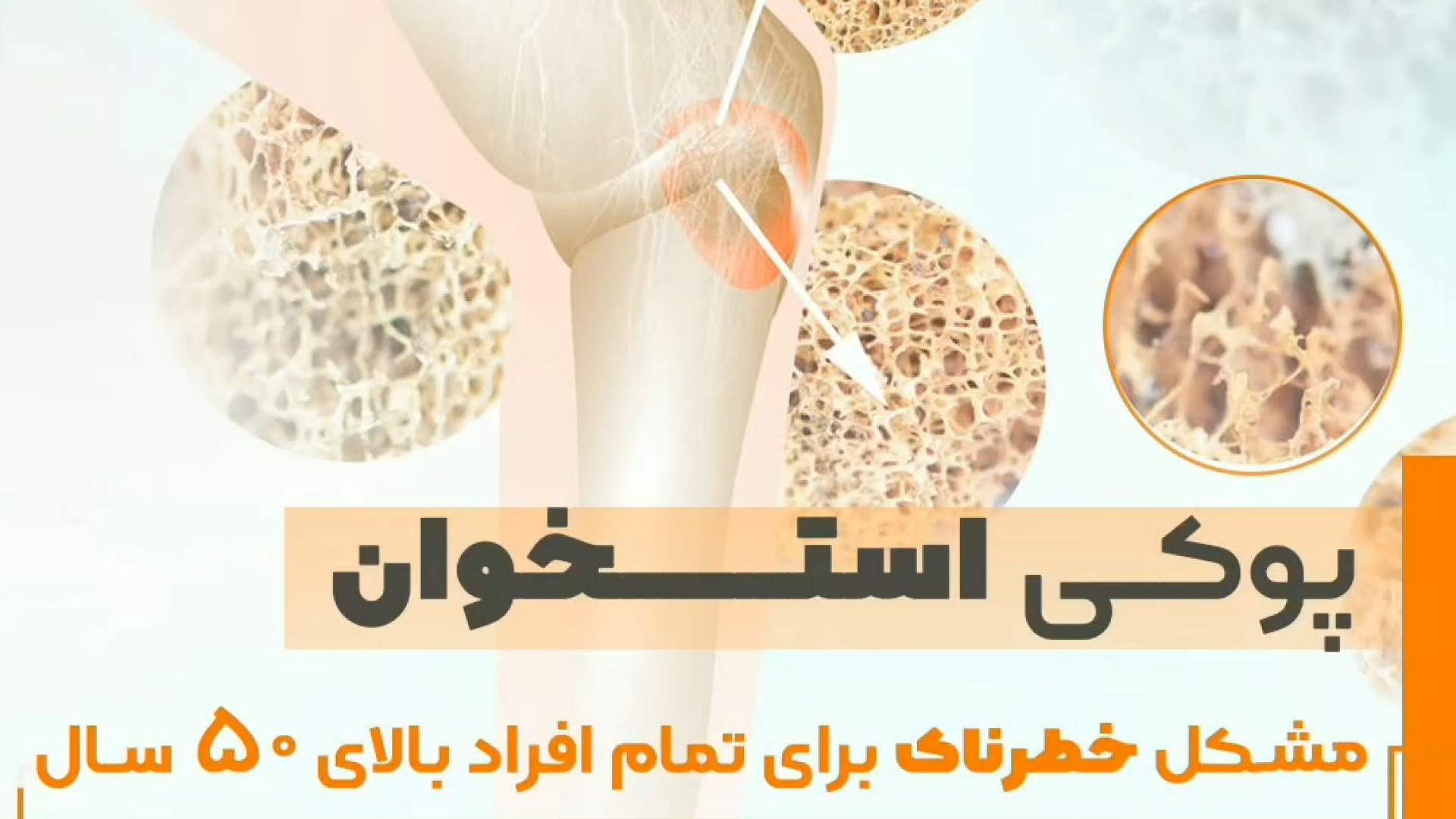 پوکی استخوان در افراد بالای 50 سال هایفوتراپی