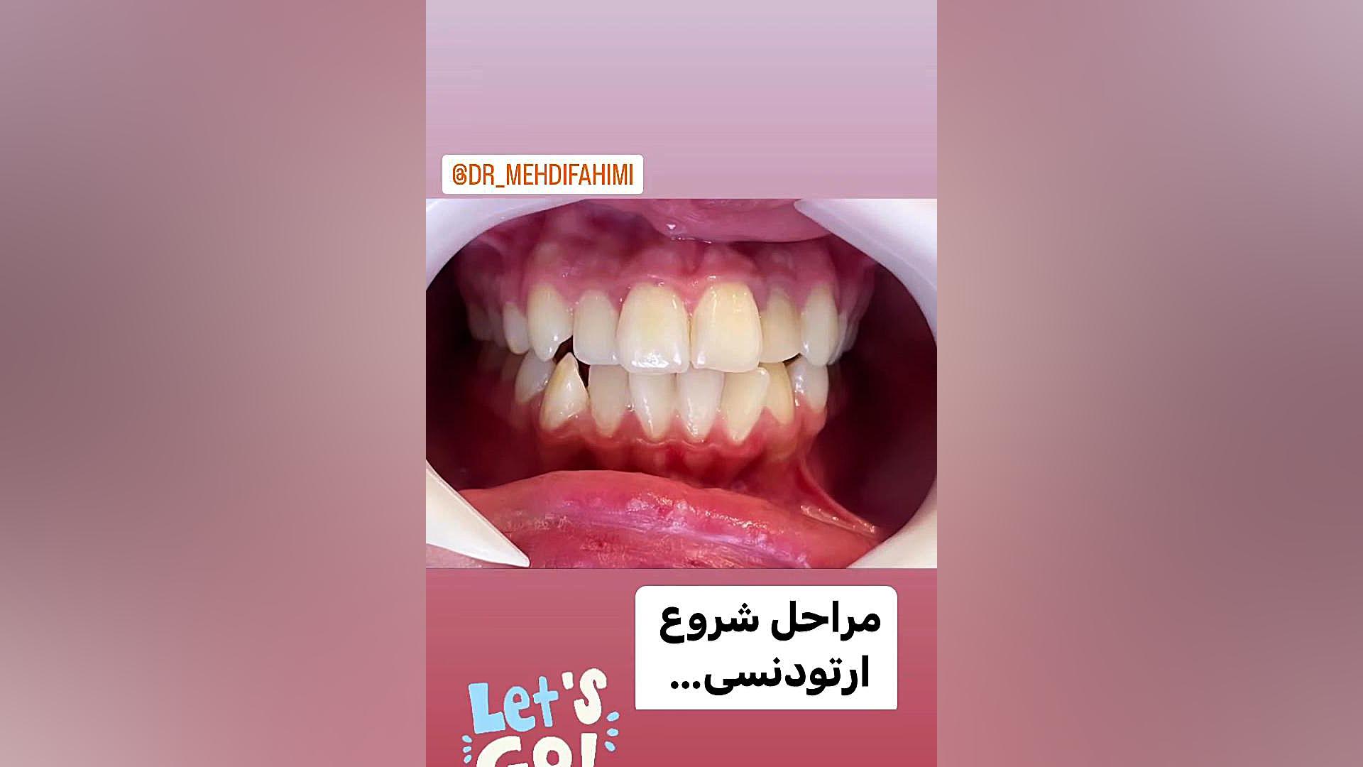 مراحل ارتودنسی دكتر مهدي فهيمي هنزائي