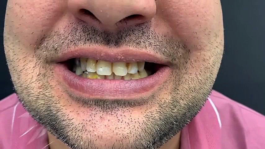 درمان ترکیبی ایمپلنت ، روکش و لمینیت سرامیکی | دکتر محمد عاطفت اصفهان دکتر محمد عاطفت متخصص ترمیمی و زیبایی اصفهان