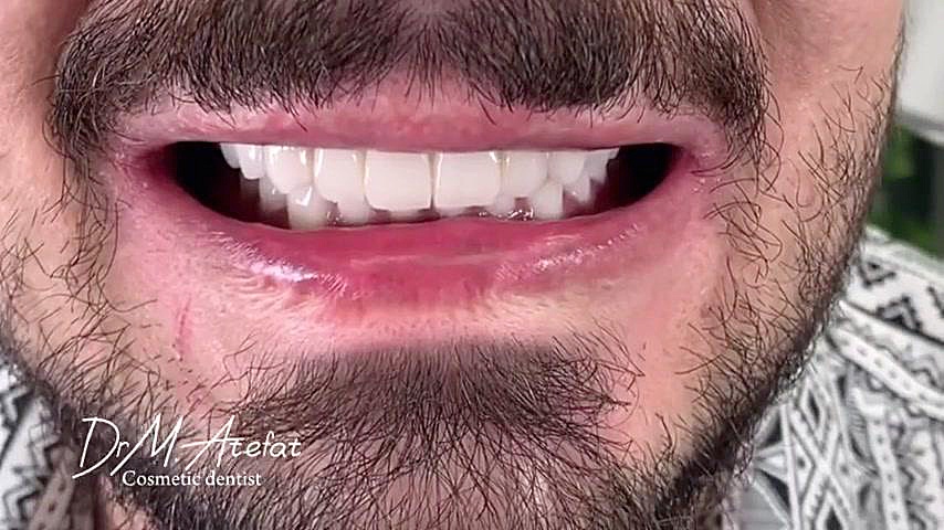 لمینت سرامیک در اصفهان | دکتر محمد عاطفت متخصص دندانپزشکی زیبایی دکتر محمد عاطفت متخصص ترمیمی و زیبایی اصفهان
