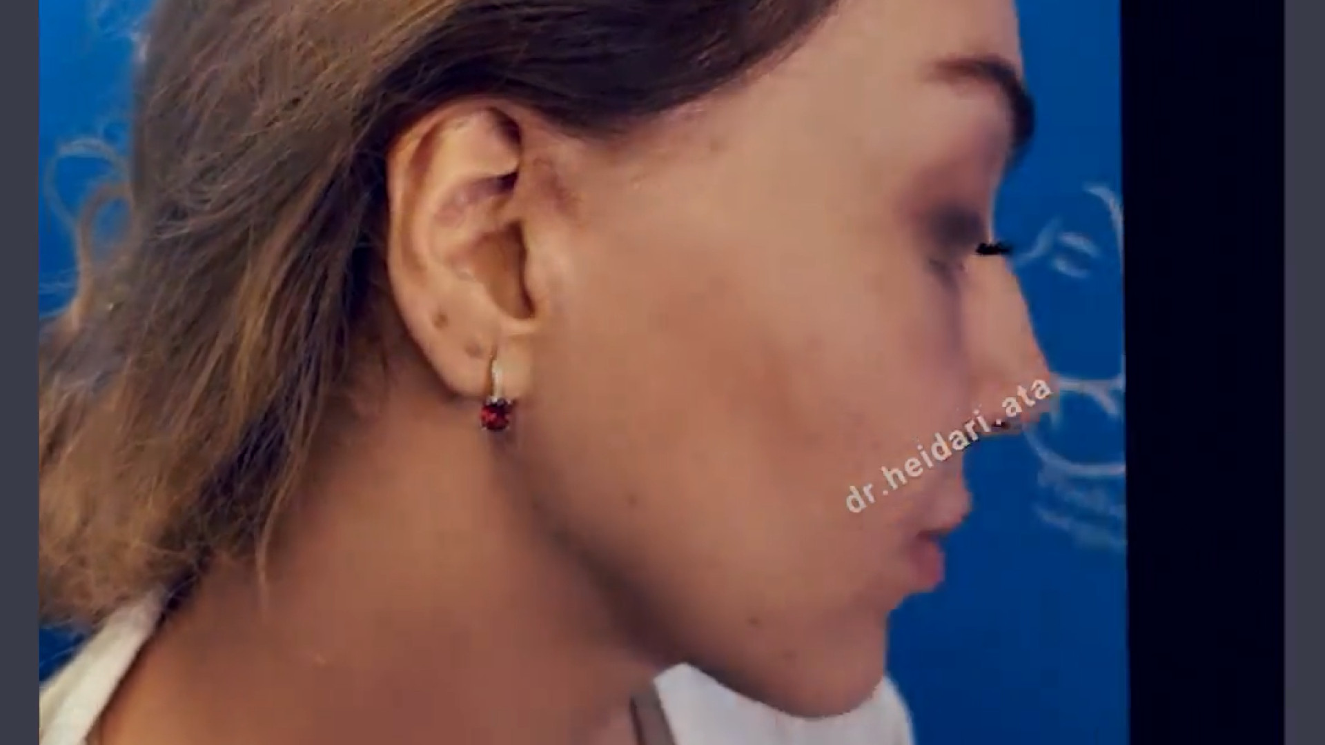 یک سال و نیم پس از جراحی لیفت کامل صورت ، گردن و پیشانی زوترلینیب