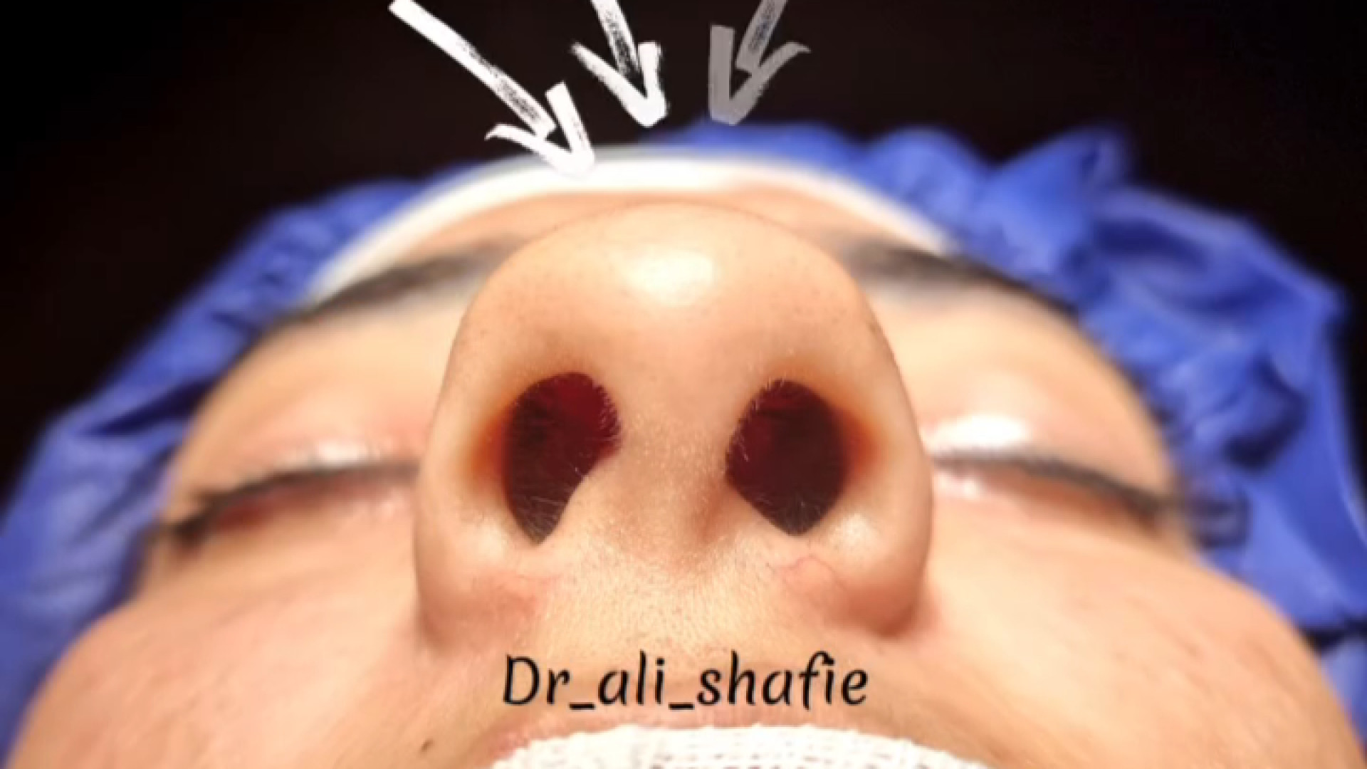 بلافاصله بعد از عمل در بینی گوشتی با نوک پهن دکتر علی شفیعی رونیزی | بهترین جراح بینی تهران