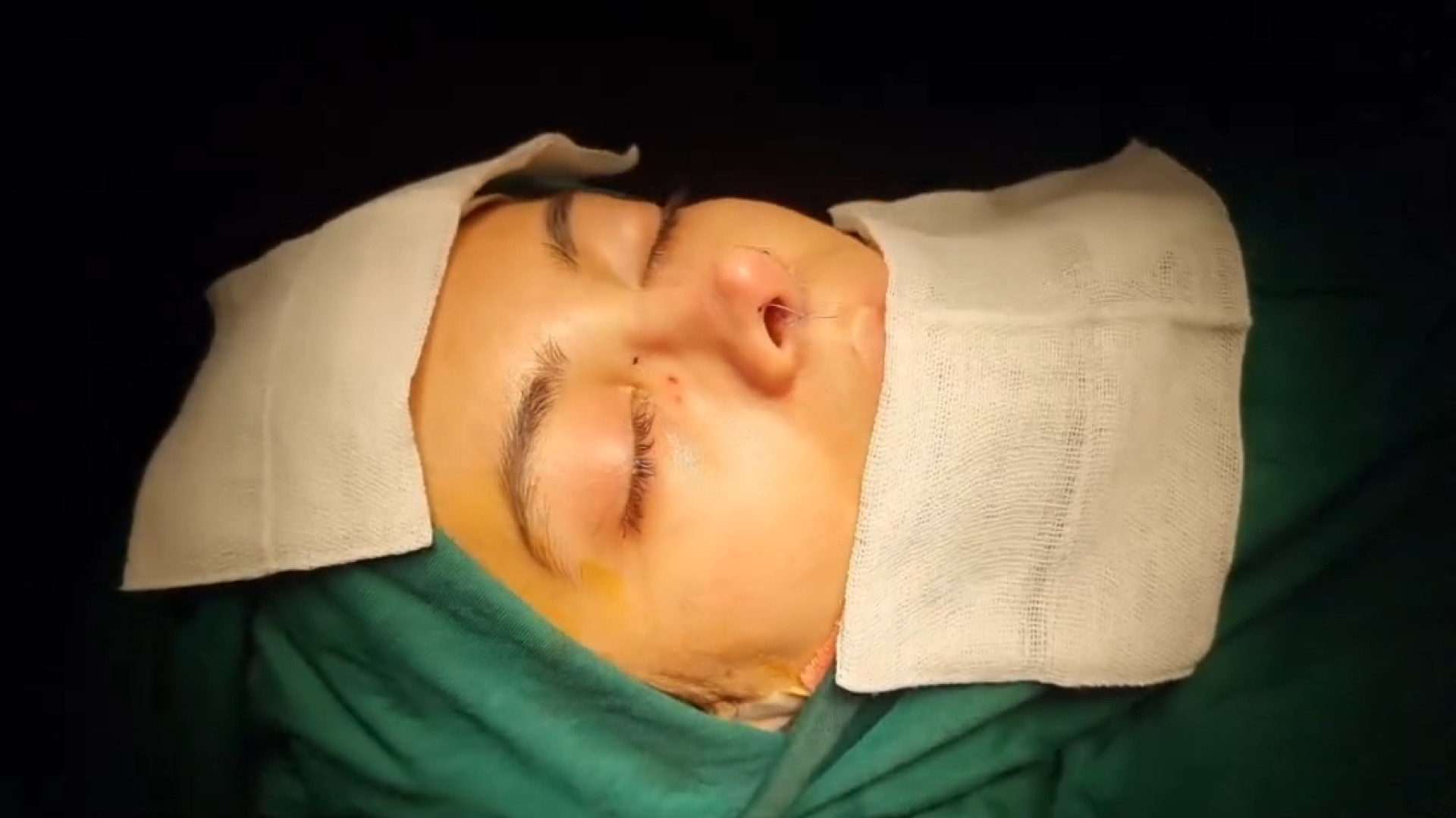 نتیجه عالی از جراحی بینی استخوانی دکتر علی شفیعی رونیزی | بهترین جراح بینی تهران
