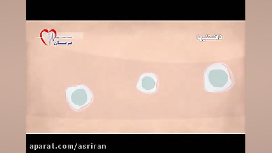 درباره سرطان خون چه می دانید کاشت مو