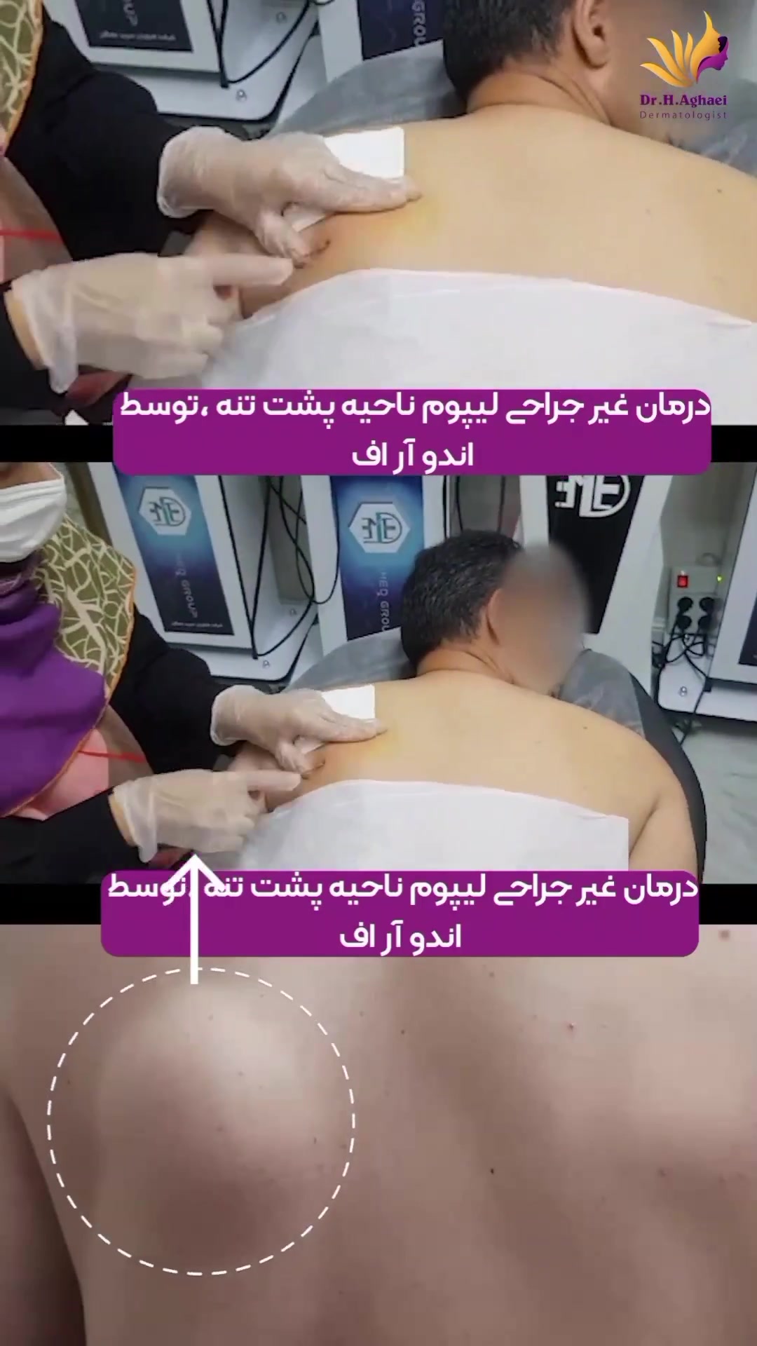 درمان لیپوم با اندو آر اف دکتر حمیده آقایی
