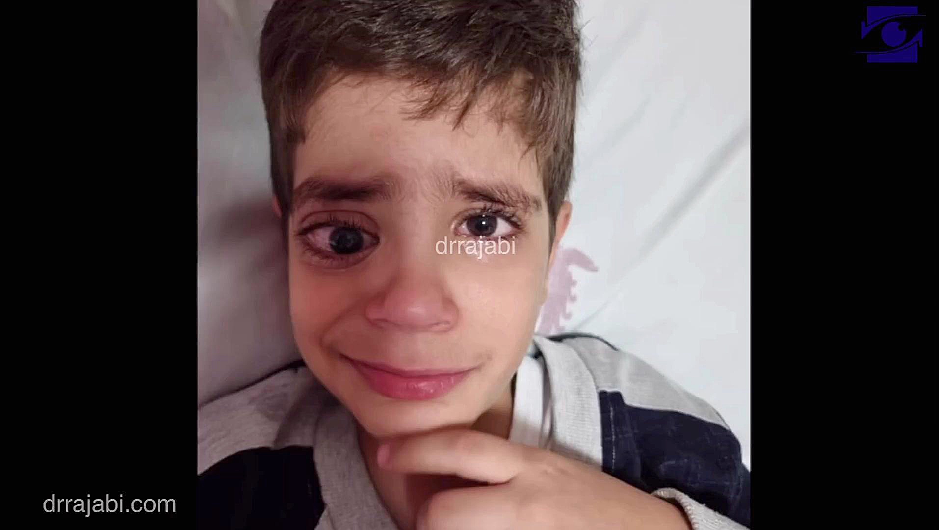 جراحی تومور مننژیوم عصب بینایی در کودک5 ساله با گسترش به مغز تریلر
