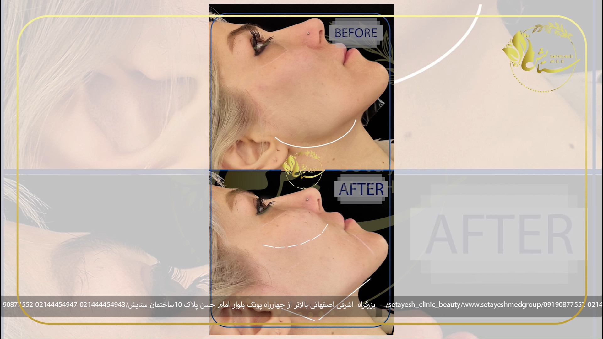 زاویه سازی صورت پریودنتیکس