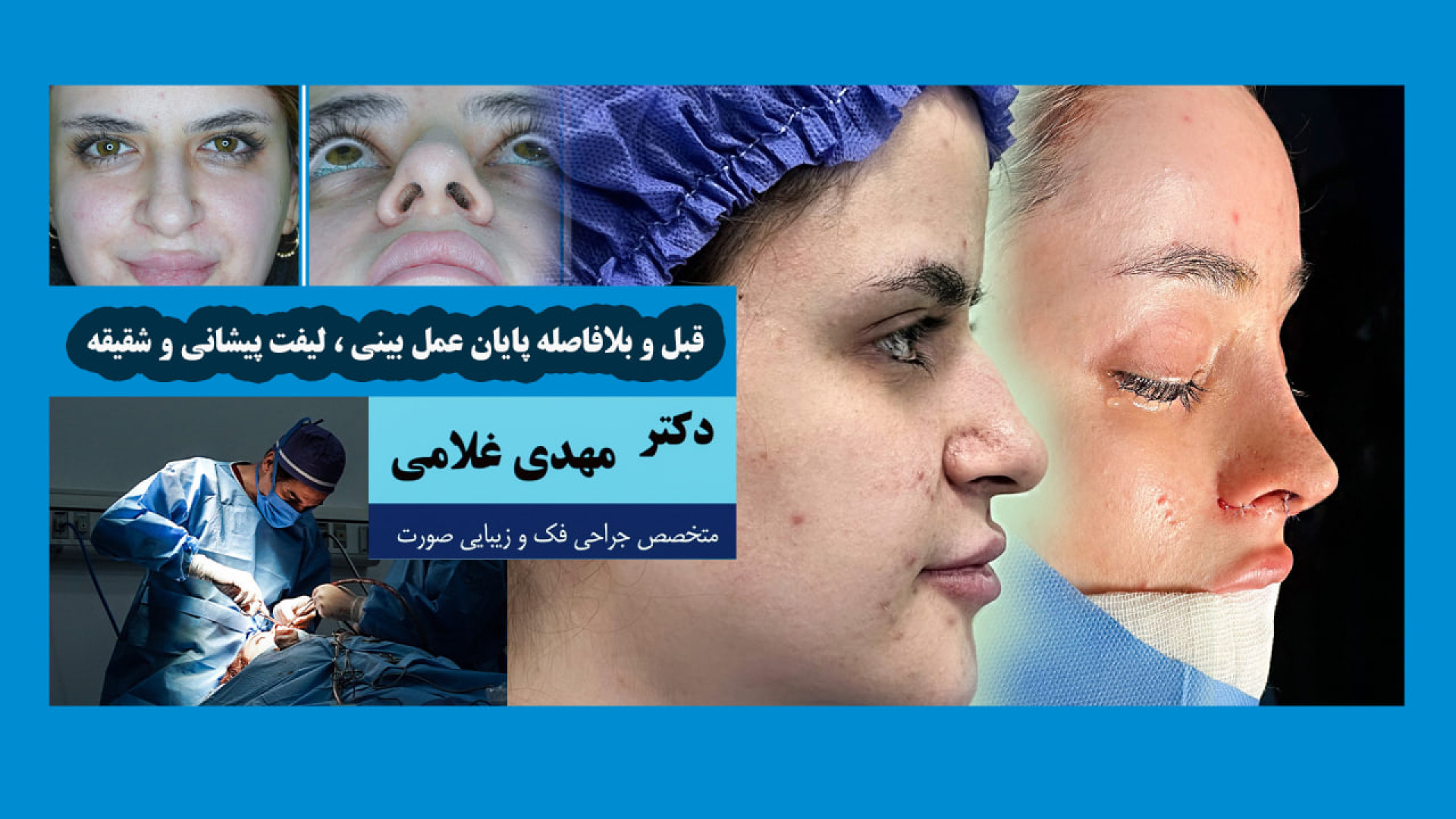 قبل و بلافاصله بعد از پایان عمل بینی، لیفت پیشانی و شقیقه با دکتر مهدی غلامی دکتر مهدی غلامی