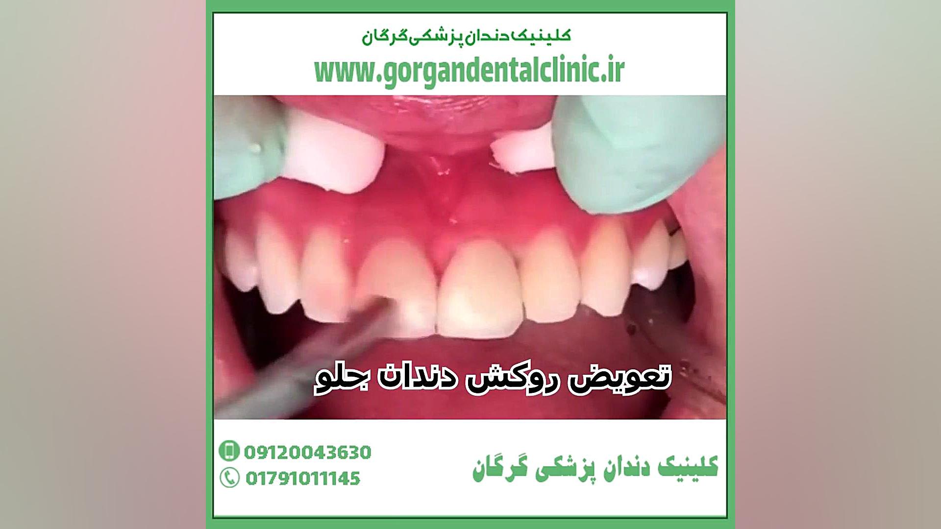 تعویض روکش دندان قارچ‌شناسی پزشکی