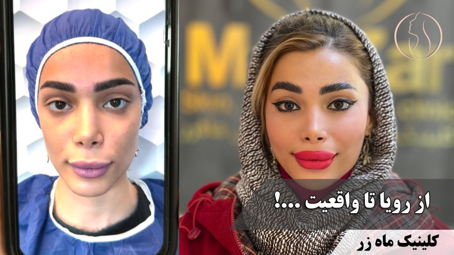 تزریق چربی از رویا تا واقعیت ( کلینیک زماه زر )