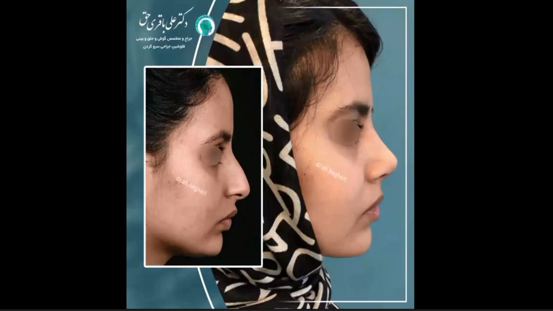 جراحی زیبایی بینی | دکتر باقری حق دکتر علی باقری حق