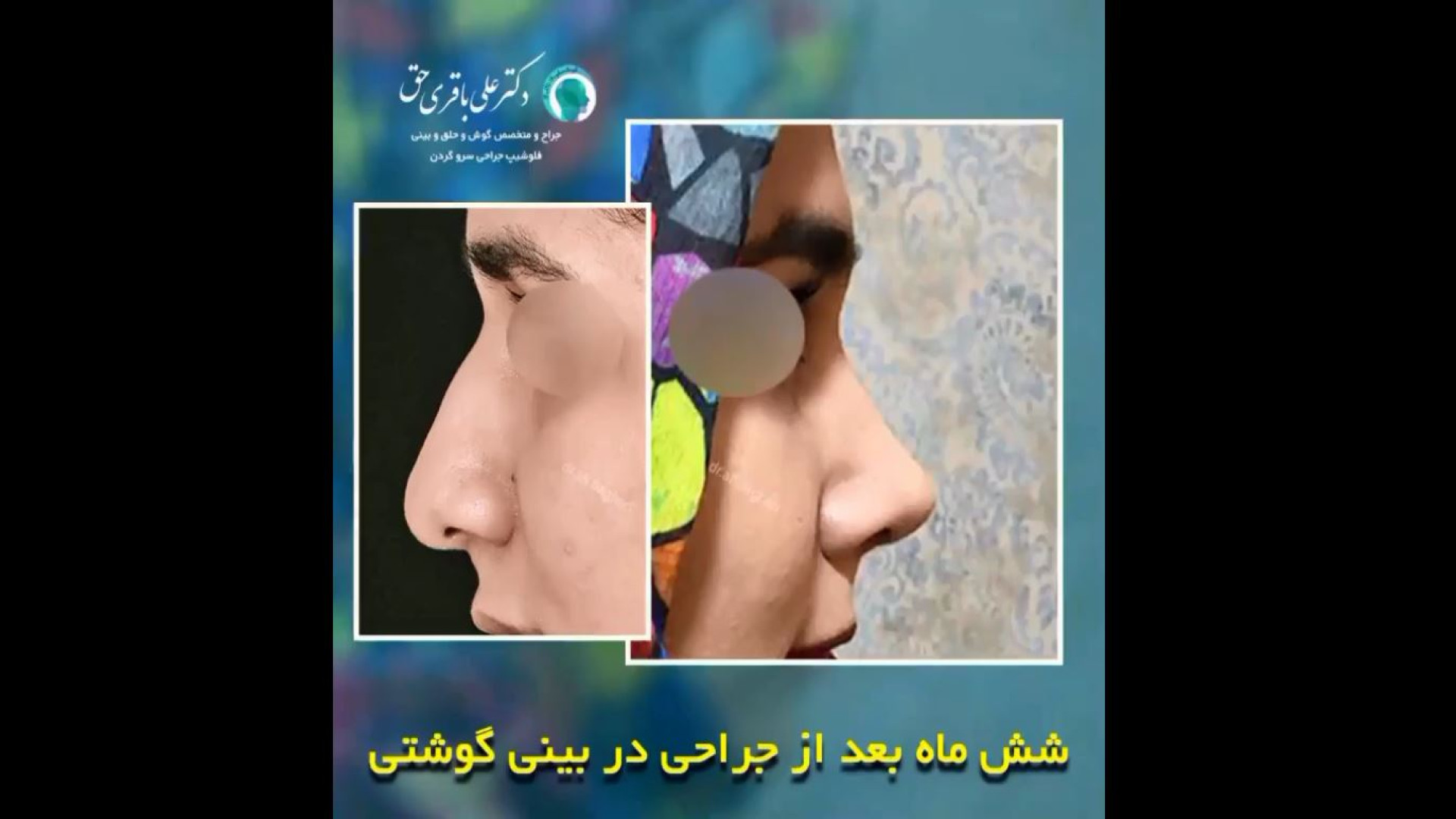 شش ماه بعد از جراحی بینی گوشتی | دکتر باقری حق دکتر علی باقری حق