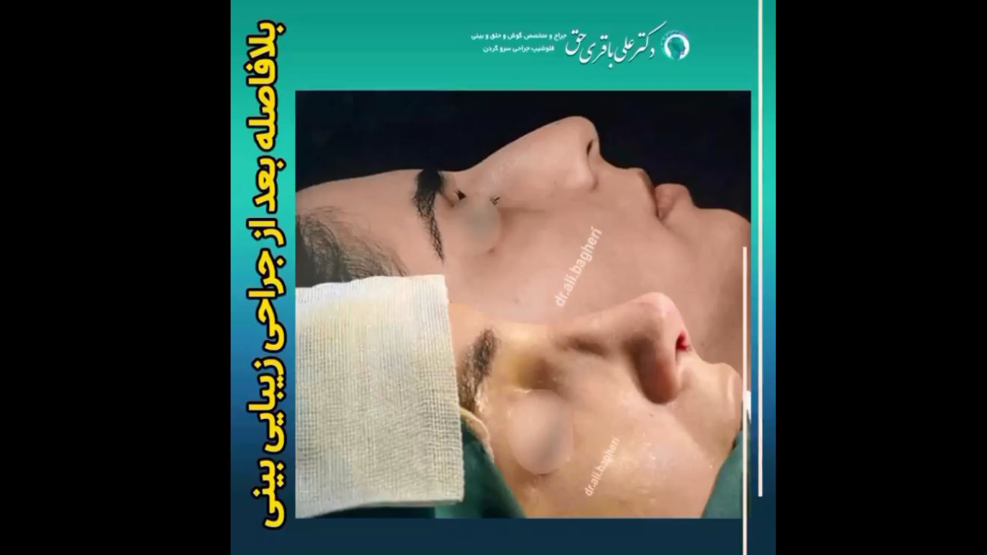 بلافاصله بعد از جراحی زیبایی بینی | دکتر باقری حق دکتر علی باقری حق