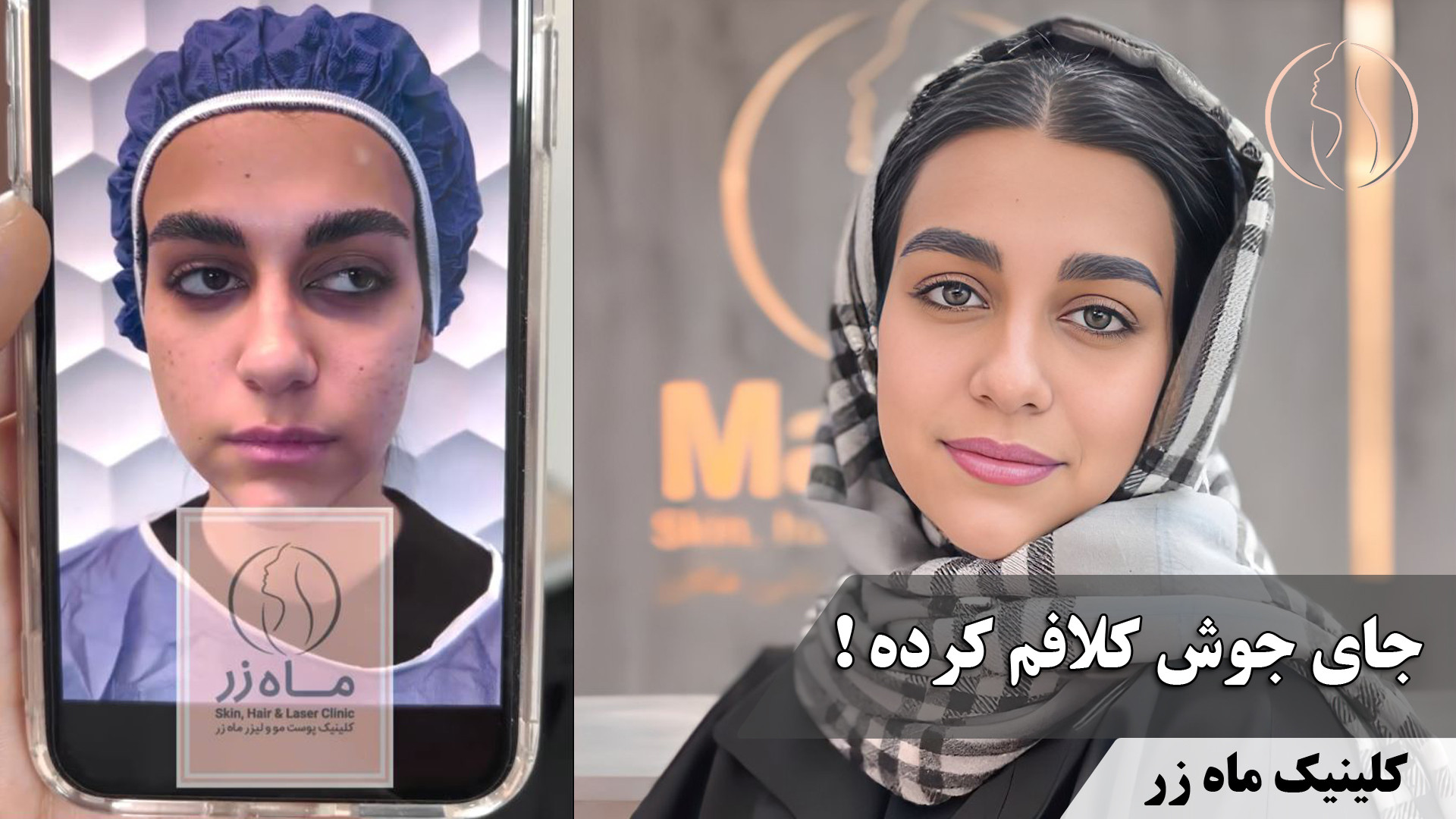 راه حل درمان جوش ( کلینیک زیبایی ماه زر ) آکنه