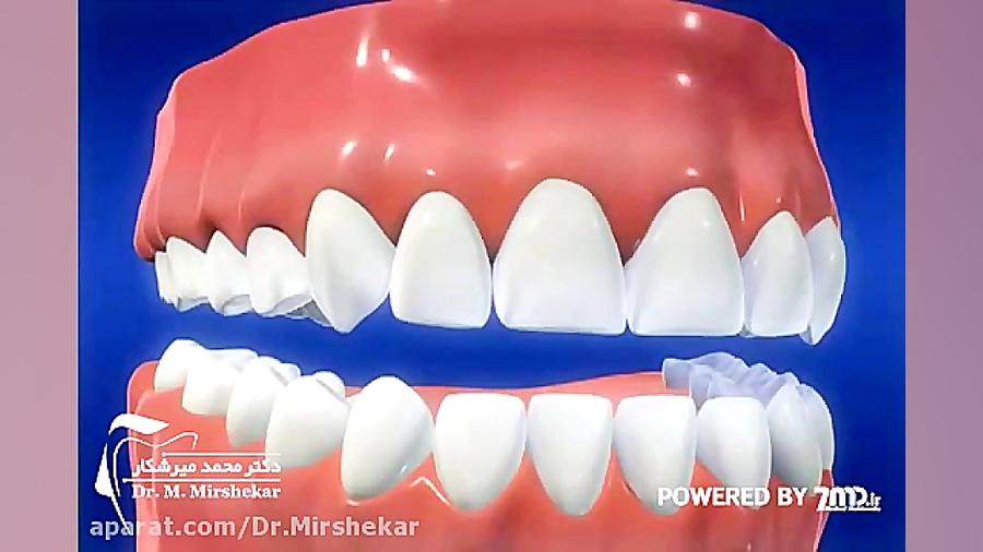 روکش دندان میکروسفالی