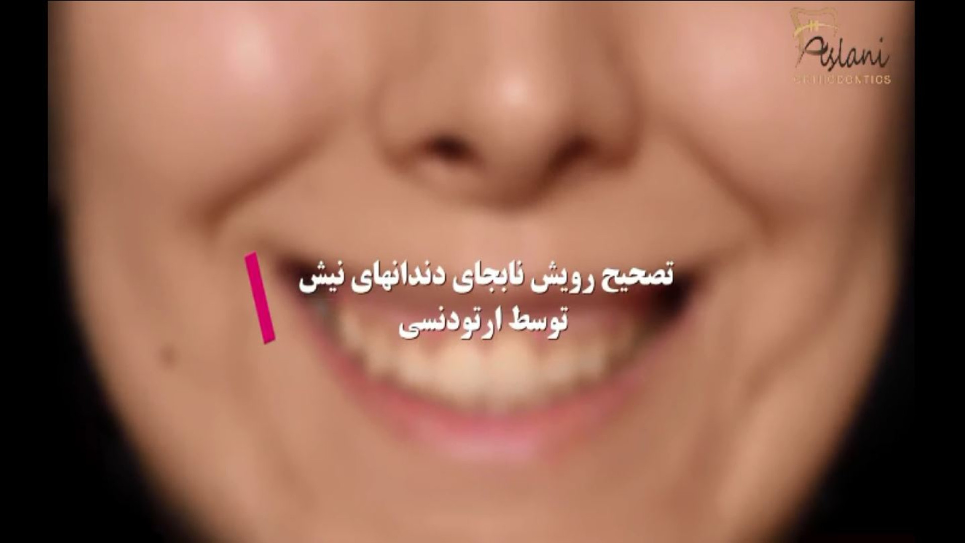 تصحیح رویش نابه جای دندان های نیش با ارتودنسی توسط دکتر اصلانی میکروسفالی
